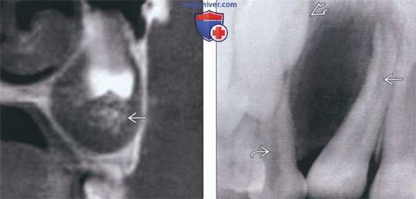 Лучевая диагностика аденоматоидной одонтогенной опухоли челюсти