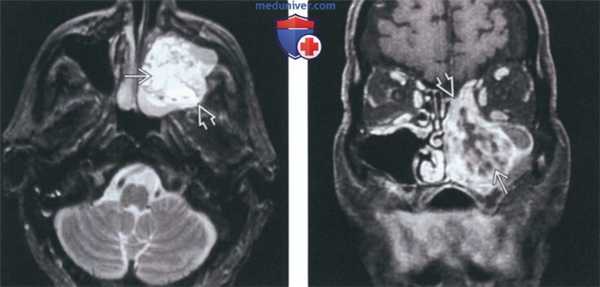 Рентгенограмма, КТ, МРТ при амелобластоме челюсти