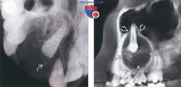 Лучевая диагностика аденоматоидной одонтогенной опухоли челюсти
