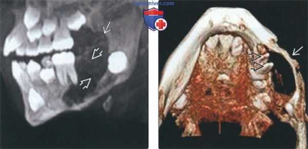 Рентгенограмма, КТ при амелобластической фиброме челюсти