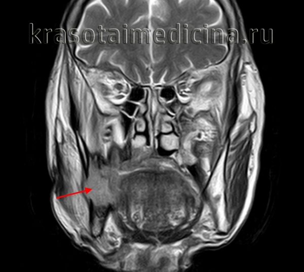 Амелобластома