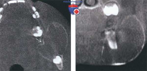 Рентгенограмма, КТ при амелобластической фиброме челюсти