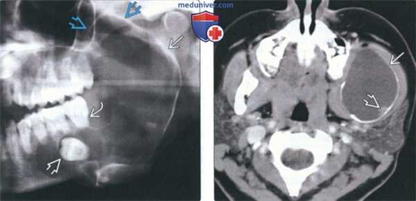 Рентгенограмма, КТ, МРТ при амелобластоме челюсти