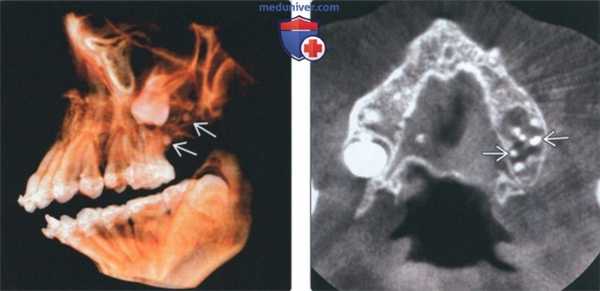 Лучевая диагностика амелобластической фиброодонтомы челюсти