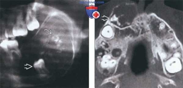 Лучевая диагностика амелобластической фиброодонтомы челюсти