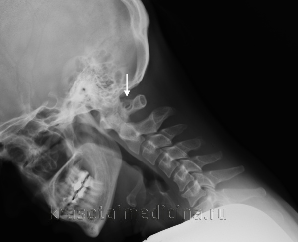 Аномалия Кимерли