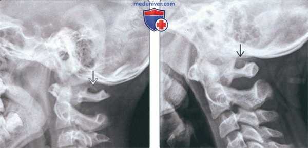 Лучевая диагностика аномалии Киммерле
