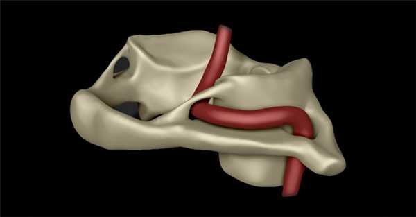 Case courtesy of Dr Matt Skalski, Radiopaedia.org, rID: 52537