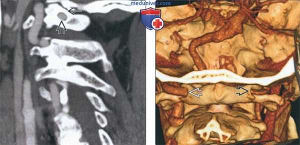 Лучевая диагностика аномалии Киммерле