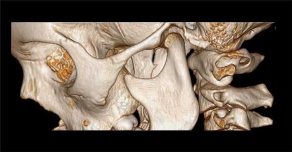Kimerle anomaly CT 3D