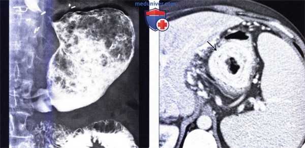 Лучевая диагностика безоара желудка