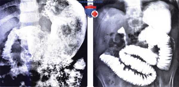 Лучевая диагностика безоара желудка