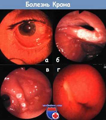 Болезнь Крона