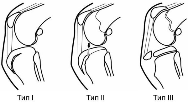 Типы отрывных переломов