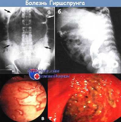 Болезнь Гиршспрунга