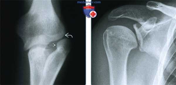 Болезнь Фонга (синдром ногтя-надколенника) - лучевая диагностика