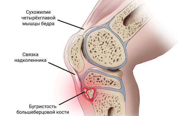 Бугристость большеберцовой кости