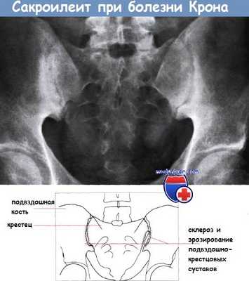 Сакроилеит при болезни Крона
