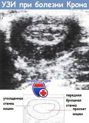 УЗИ при болезни Крона
