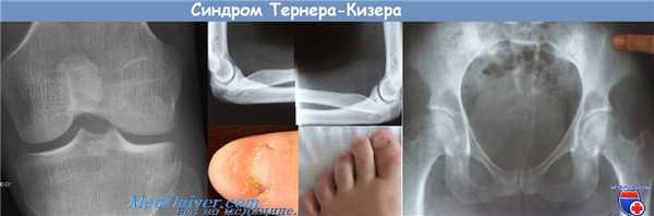 синдром Тернера-Кизера