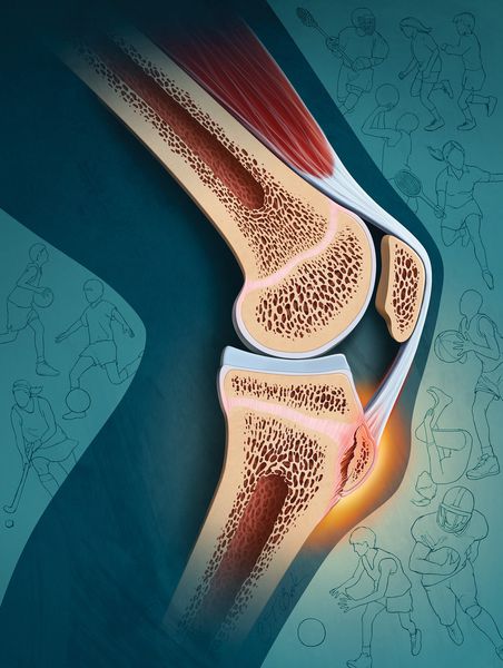 Болезнь Осгуда — Шляттера