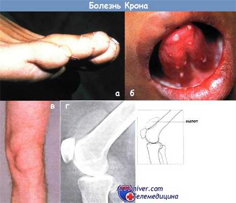 Болезнь Крона