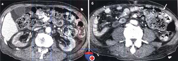 КТ при обратной ротации кишечника