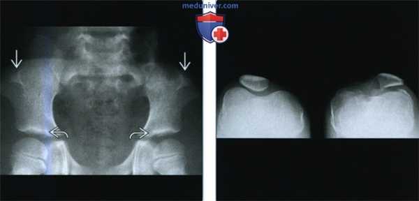 Болезнь Фонга (синдром ногтя-надколенника) - лучевая диагностика