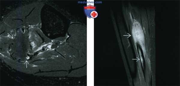 Десмопластическая фиброма - лучевая диагностика