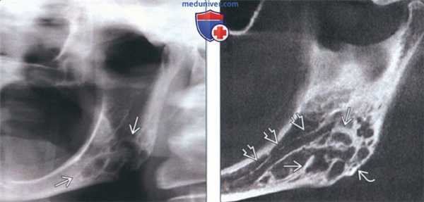 Лучевая диагностика десмопластической фибромы челюсти