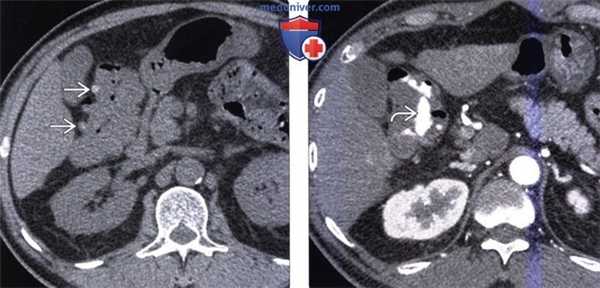 Рентгенограмма, КТ при дивертикулезе толстой кишки