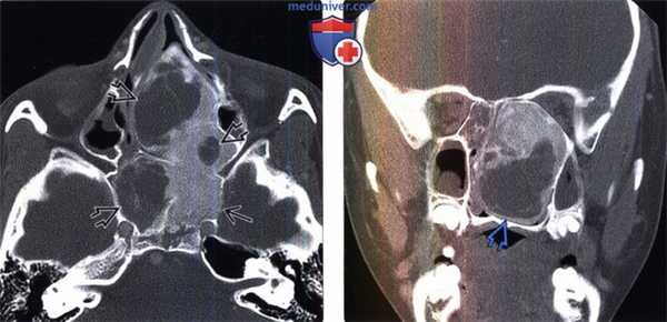 Фиброзная дисплазия на КТ головы
