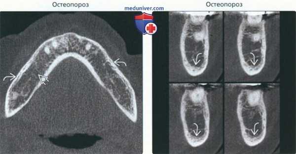 Рентгенограмма, КТ при генерализованном разряжении челюсти