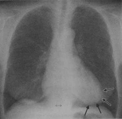 Снимки МРТ и КТ. Артериальная гипертензия