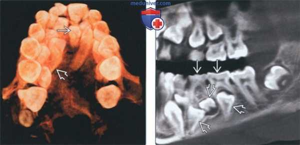 Лучевая диагностика гипердонтии