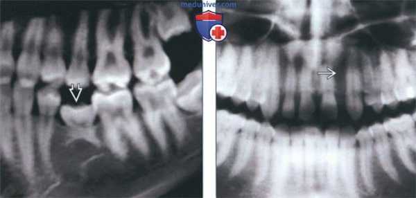 Лучевая диагностика гиподонтии