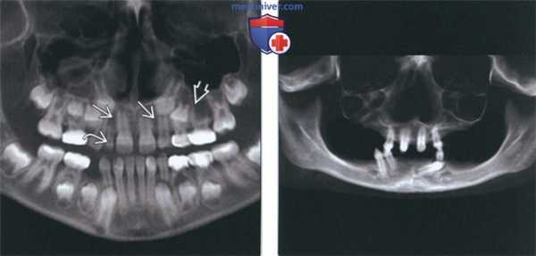 Лучевая диагностика гиподонтии