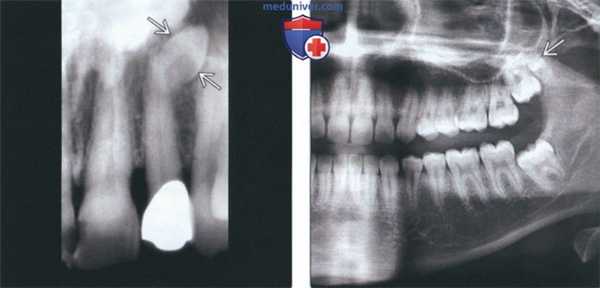 Лучевая диагностика гипердонтии