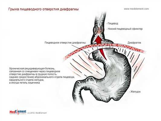 Грыжа пищеводного отверстия диафрагмы. Описание.