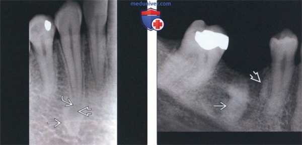 Лучевая диагностика идиопатического остеосклероза челюсти