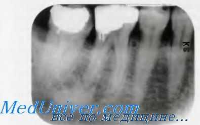 Склерозирующий остеомиелит