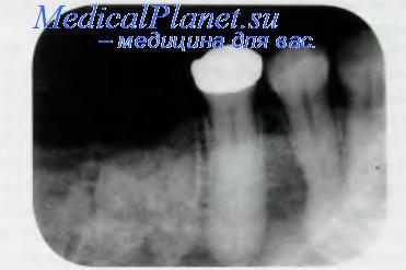 Луночный склероз