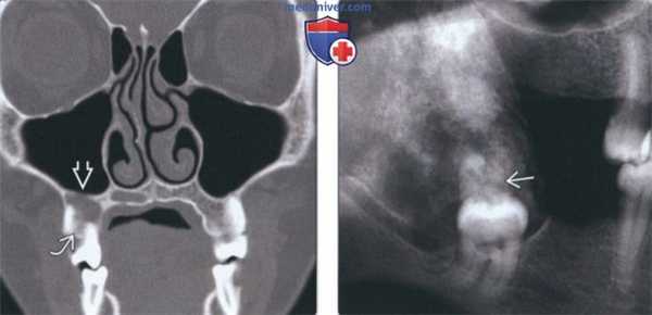 Лучевая диагностика кальцифицирующей эпителиальной одонтогенной опухоли