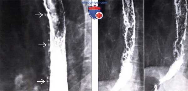 Лучевая диагностика кандидозного эзофагита