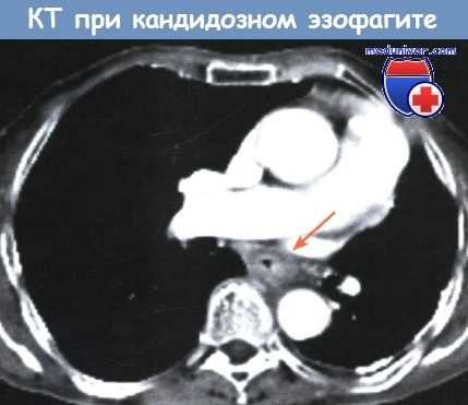 КТ при кандидозном эзофагите