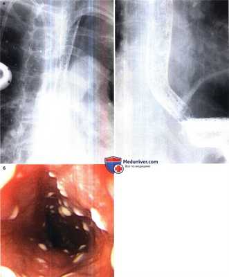 Эзофагит, вызванный грибами рода Candida
