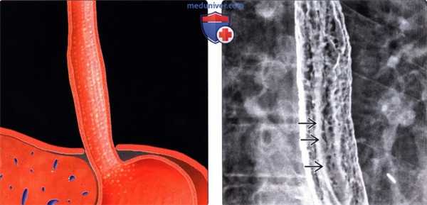 Лучевая диагностика кандидозного эзофагита