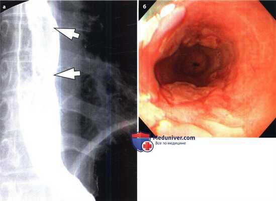 Эзофагит, вызванный цитомегаловирусом