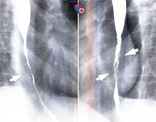 Эзофагит, вызванный грибами рода Candida