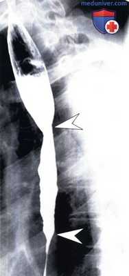 Идиопатический эозинофильный эзофагит